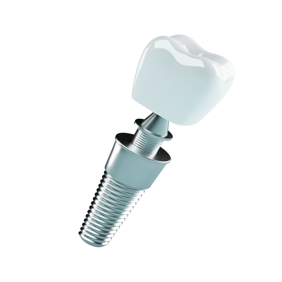 Dental Implant – Monika Dental